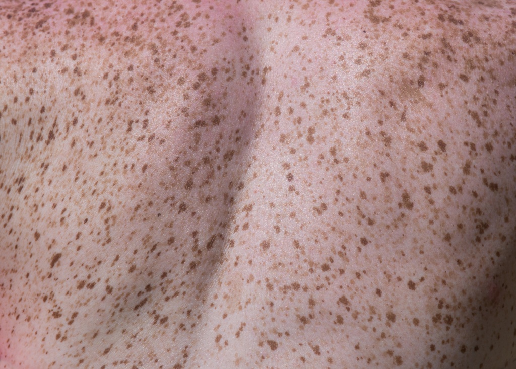 What's in a freckle? It's part gene malfunction, part sun exposure, and a dash of the unknown. 